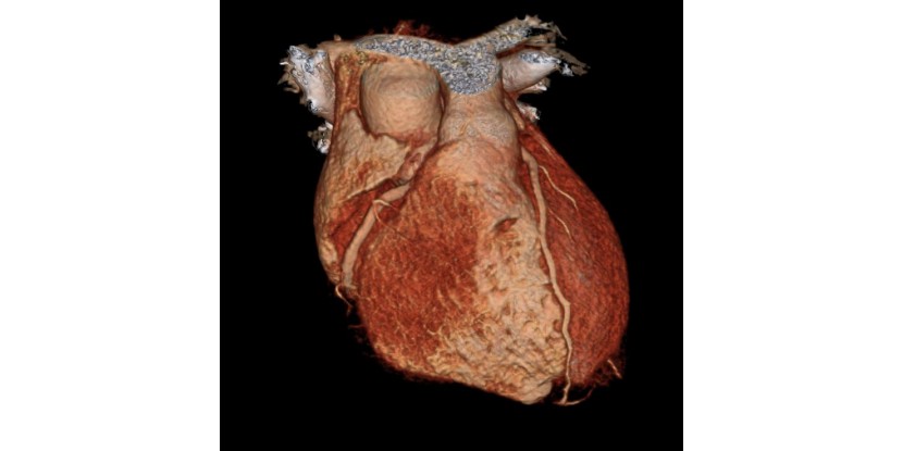 Darstellung der Herzkranzgefaesse