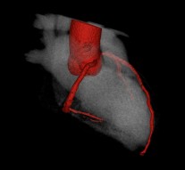 Darstellung des Herzen im CT
