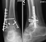 Kniegelenkprothese, Spiegelung des Kniegelenks